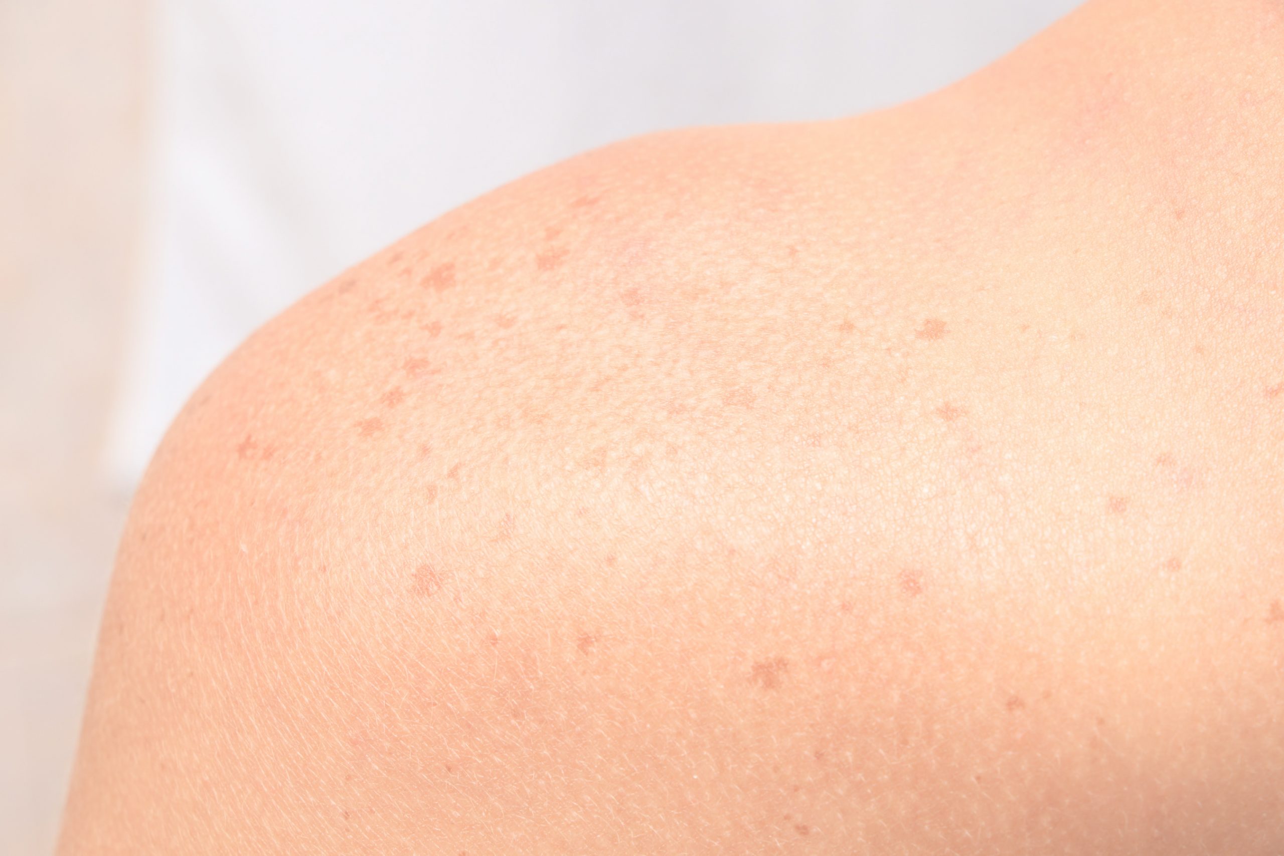 what-are-light-brown-spots-on-skin-infoupdate