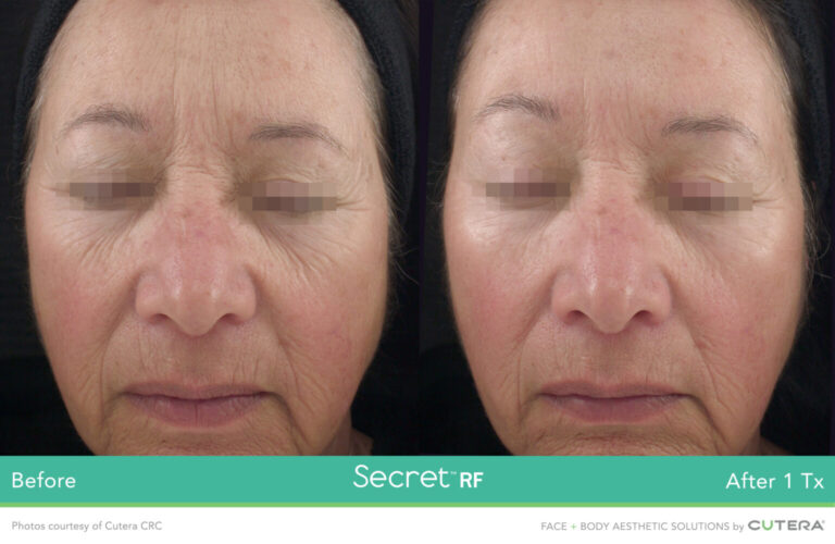 SecretRF-Cutera-CRC-P1_highres-1536x1000