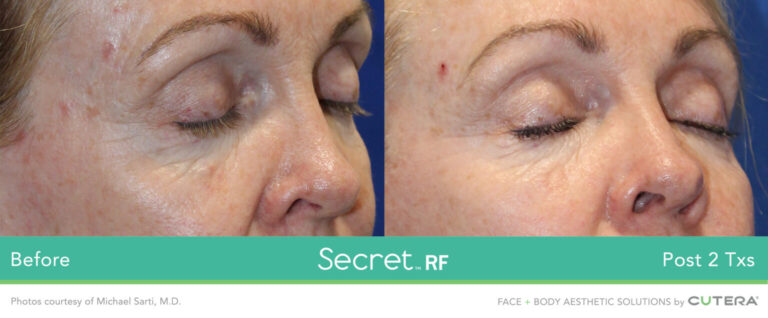 secretRF-Michael-Sarti-MD-Set3_highres-1536x635