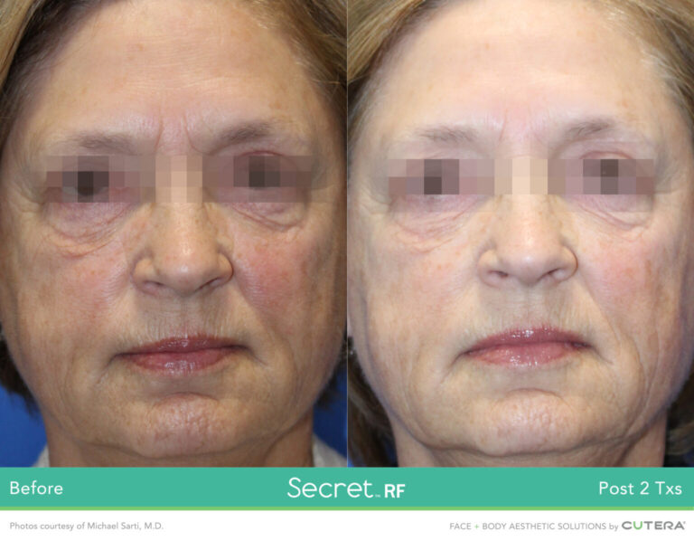 secretRF-Michael-Sarti-MD-Set6_highres-1536x1196