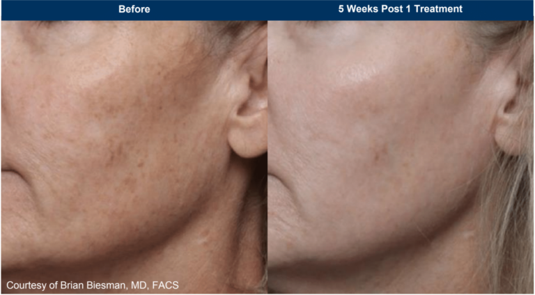 UltraClear Before and After