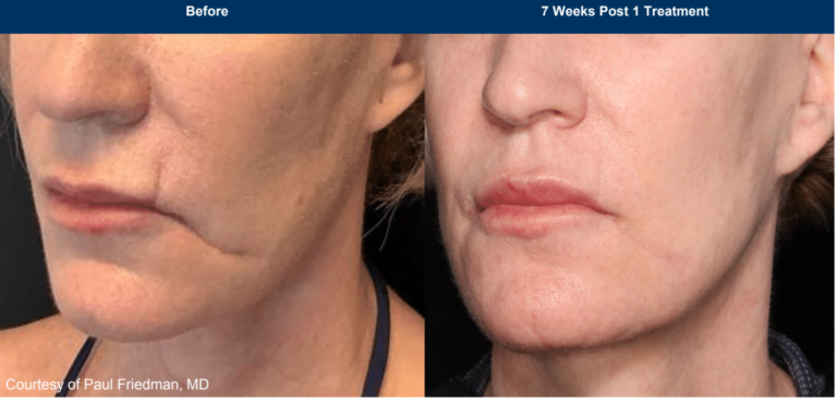 UltraClear Before and After