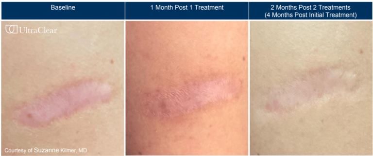 UltraClear Before and After
