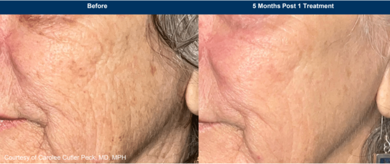 UltraClear Before and After