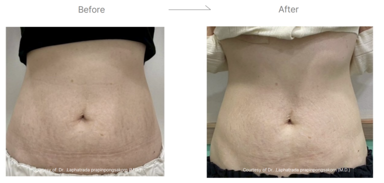 LinearZ Before & After