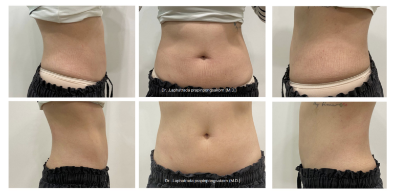 LinearZ Before & After