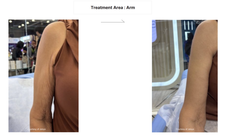 LinearZ Before & After