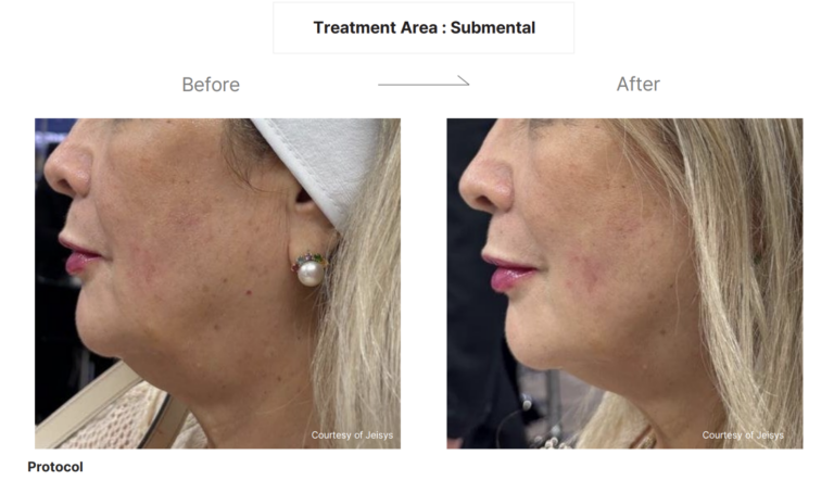 LinearZ Before & After