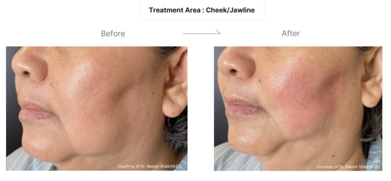 LinearZ Before & After