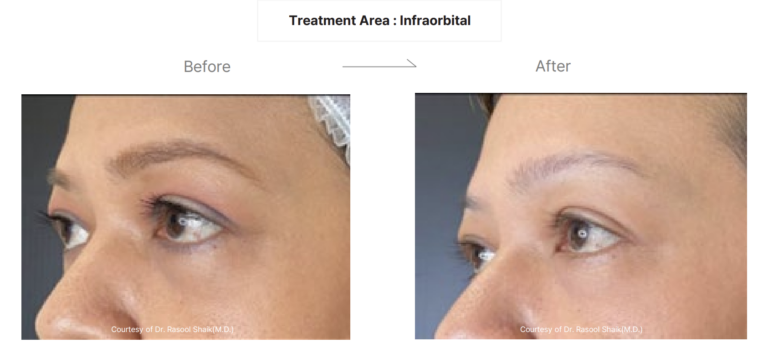 LinearZ Before & After